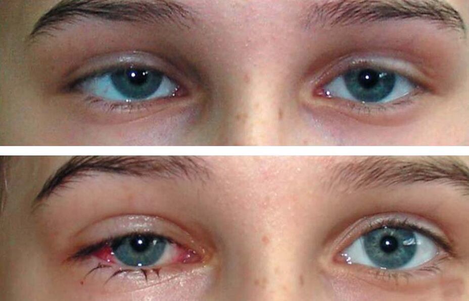 Before and after treatment Oculax