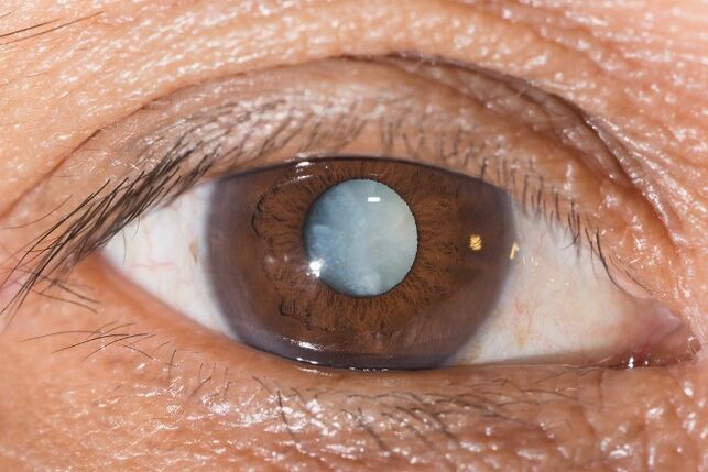 In case of cataracts, exercises are indicated to improve vision.