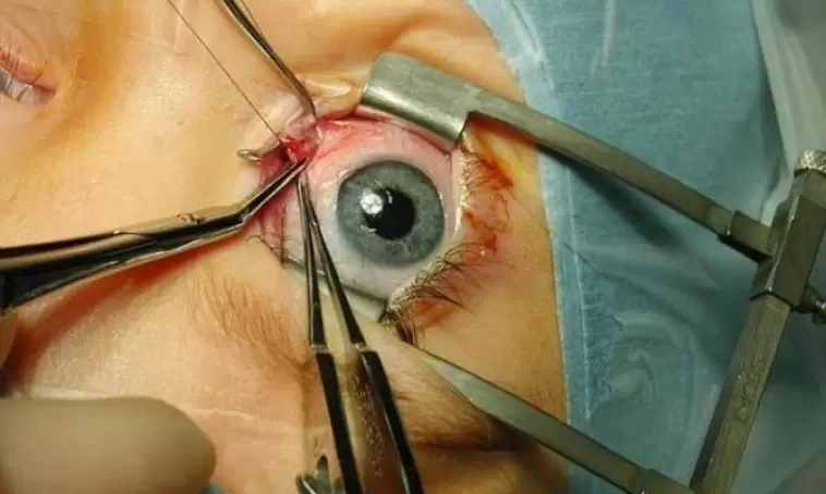 Perform eye surgery using an eyelid speculum.