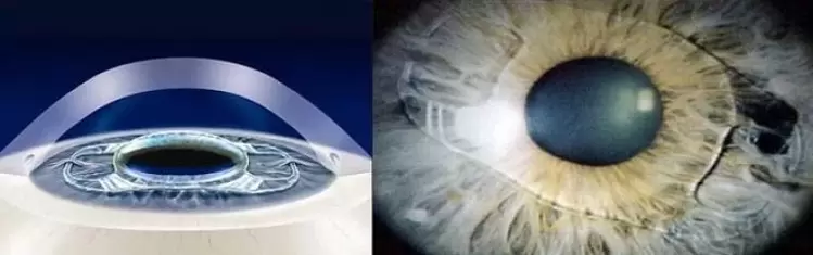 Replacing the lens of the eye with an artificial lens