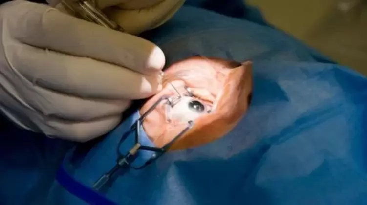 Vitrectomy removal of the vitreous humor of the eye.
